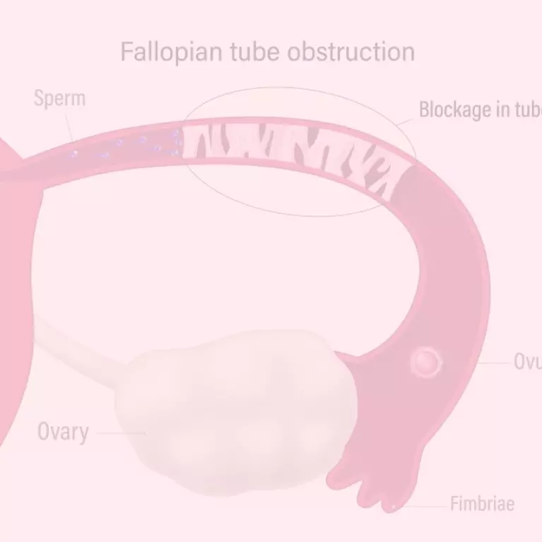 Fallopian Tube Blockage