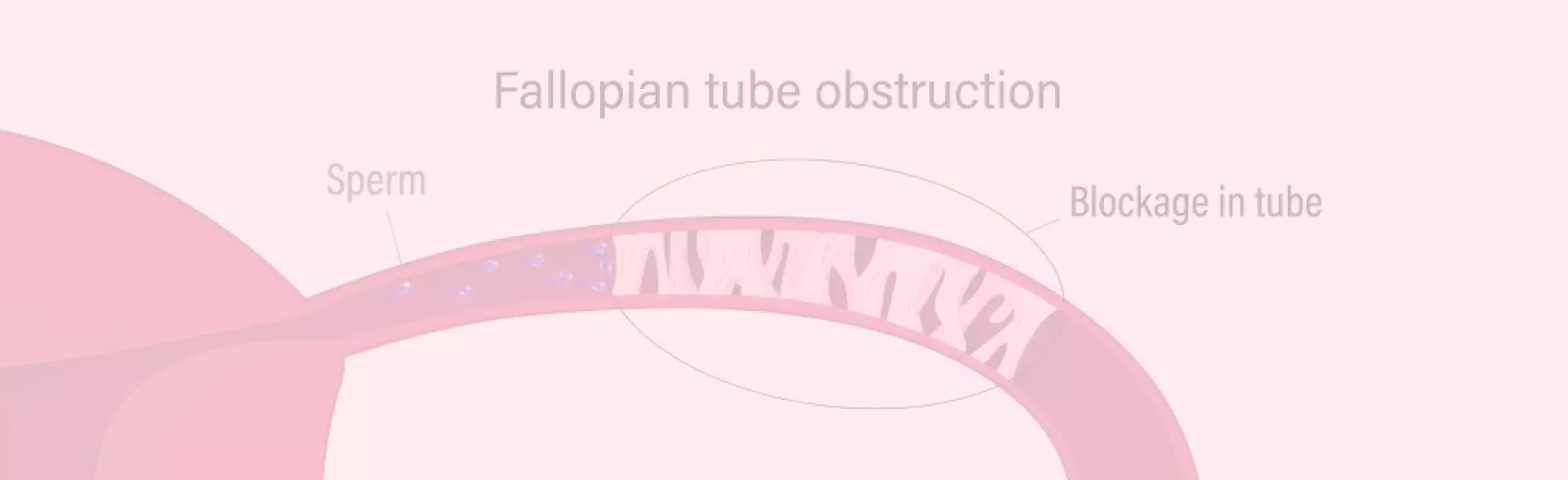 Fallopian Tube Blockage