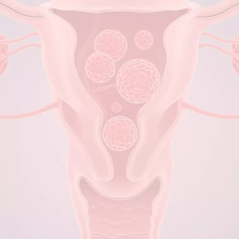 Uterine Fibroids